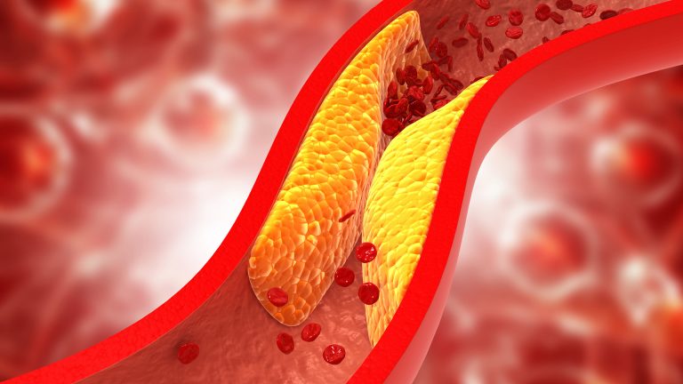 CHOLESTÉROL : COMMENT LE RÉDUIRE NATURELLEMENT ?