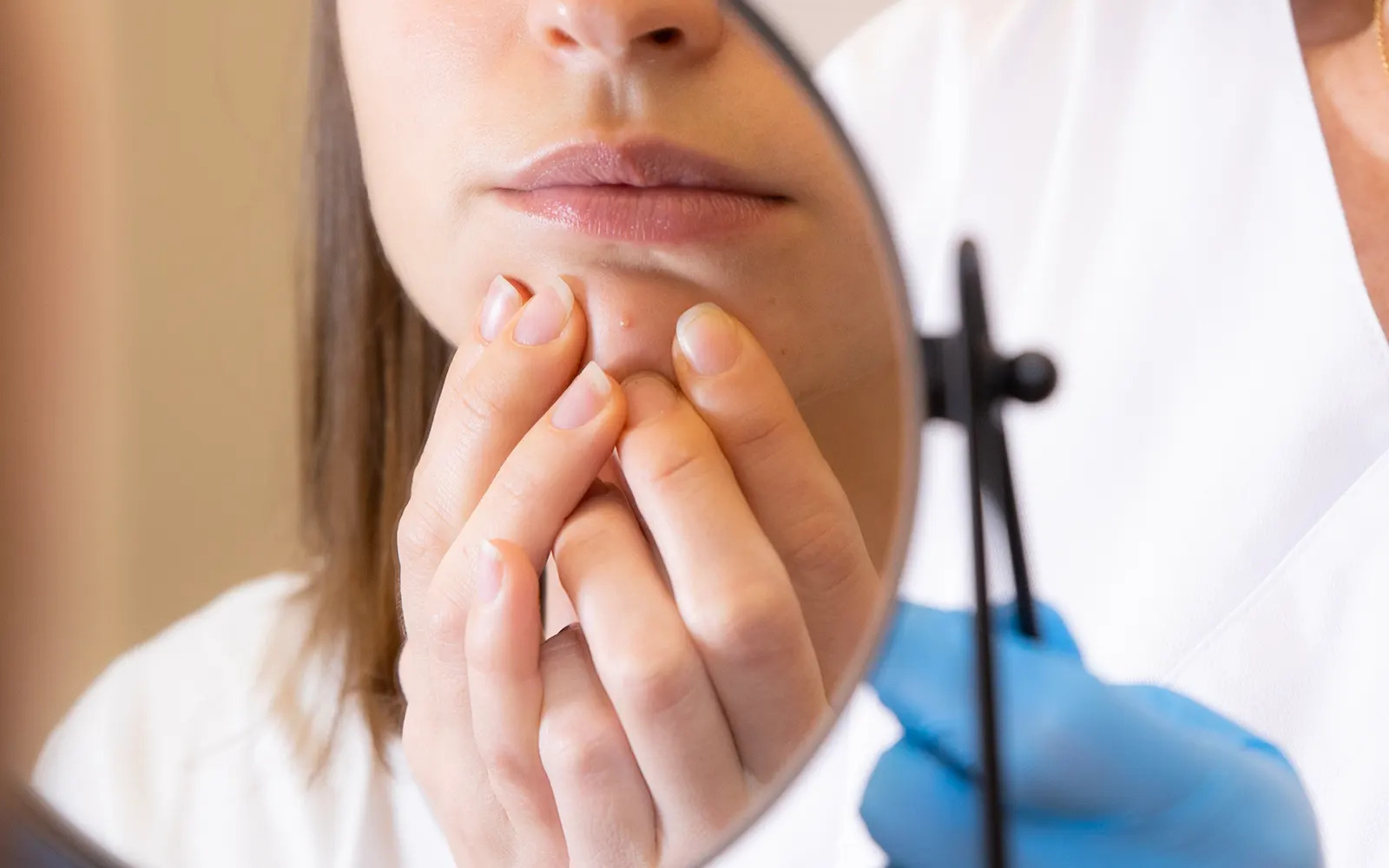 L’ACNÉ : COMPRENDRE, PRÉVENIR ET TRAITER